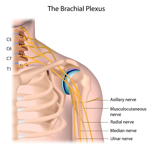 Brachial Plexus Lesion